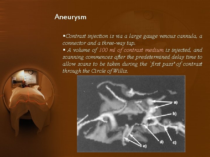 Aneurysm §Contrast injection is via a large gauge venous cannula, a connector and a