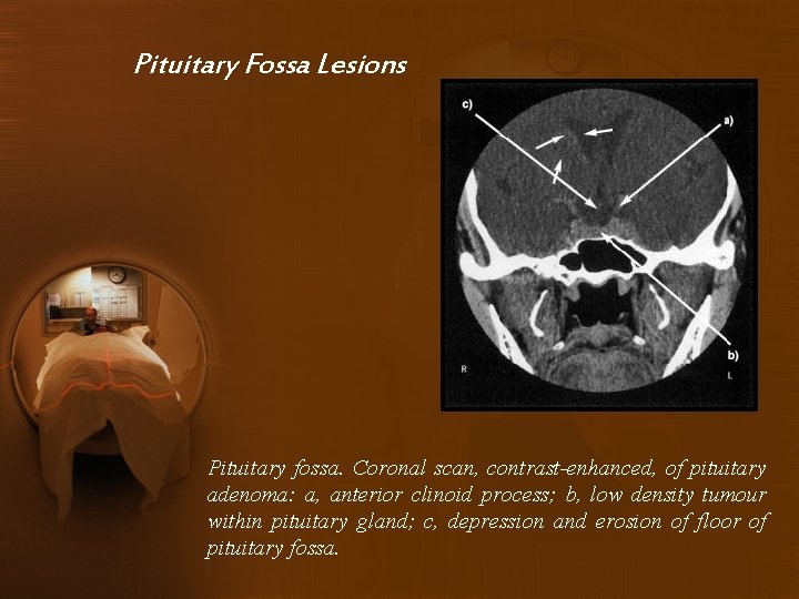 Pituitary Fossa Lesions Pituitary fossa. Coronal scan, contrast-enhanced, of pituitary adenoma: a, anterior clinoid