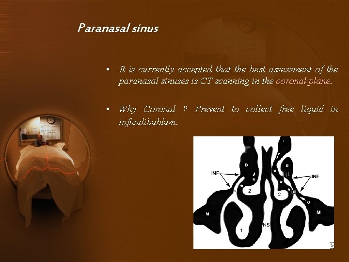 Paranasal sinus • It is currently accepted that the best assessment of the paranasal