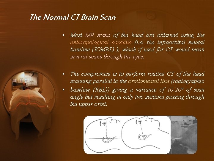 The Normal CT Brain Scan • Most MR scans of the head are obtained