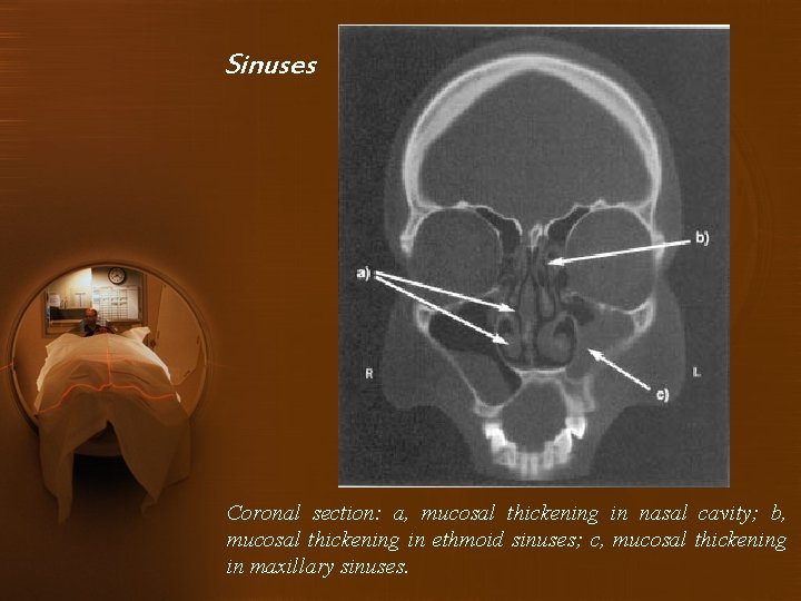 Sinuses Coronal section: a, mucosal thickening in nasal cavity; b, mucosal thickening in ethmoid