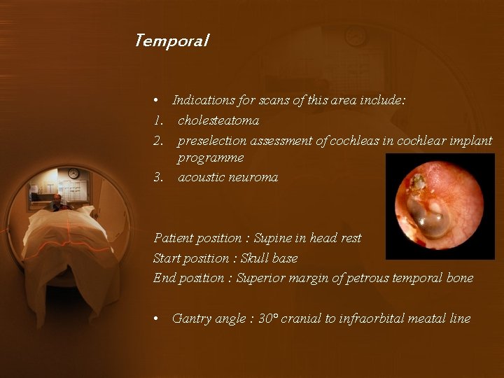 Temporal • Indications for scans of this area include: 1. cholesteatoma 2. preselection assessment