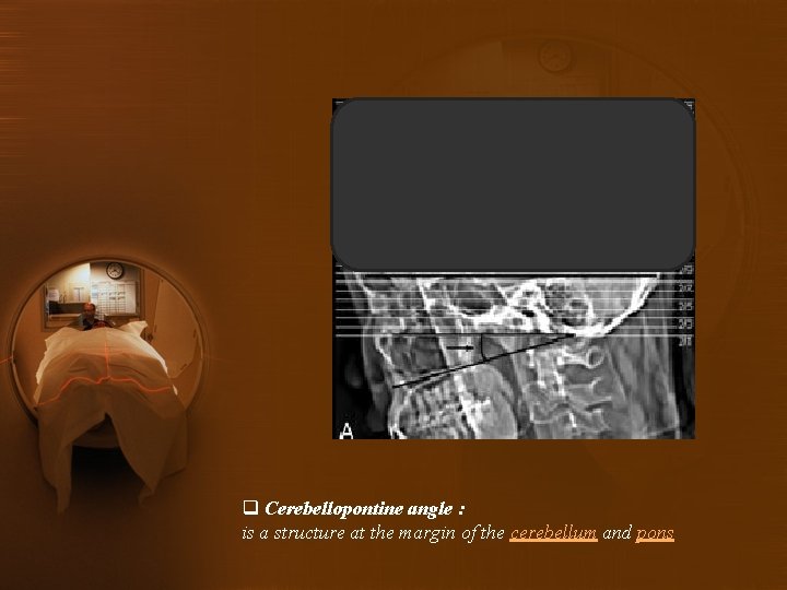 q Cerebellopontine angle : is a structure at the margin of the cerebellum and