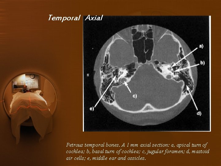 Temporal Axial Petrous temporal bones. A 1 mm axial section: a, apical turn of