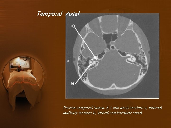 Temporal Axial Petrous temporal bones. A 1 mm axial section: a, internal auditory meatus;