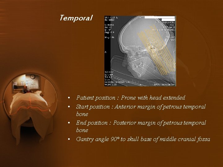 Temporal • Patient position : Prone with head extended • Start position : Anterior