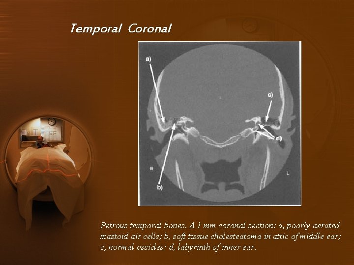 Temporal Coronal Petrous temporal bones. A 1 mm coronal section: a, poorly aerated mastoid