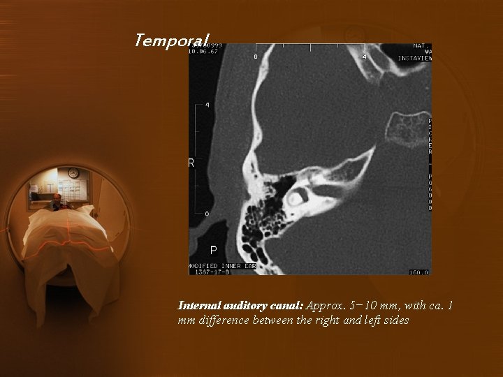 Temporal Internal auditory canal: Approx. 5− 10 mm, with ca. 1 mm difference between