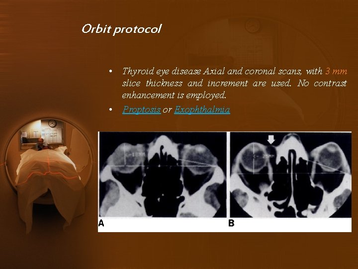 Orbit protocol • Thyroid eye disease Axial and coronal scans, with 3 mm slice