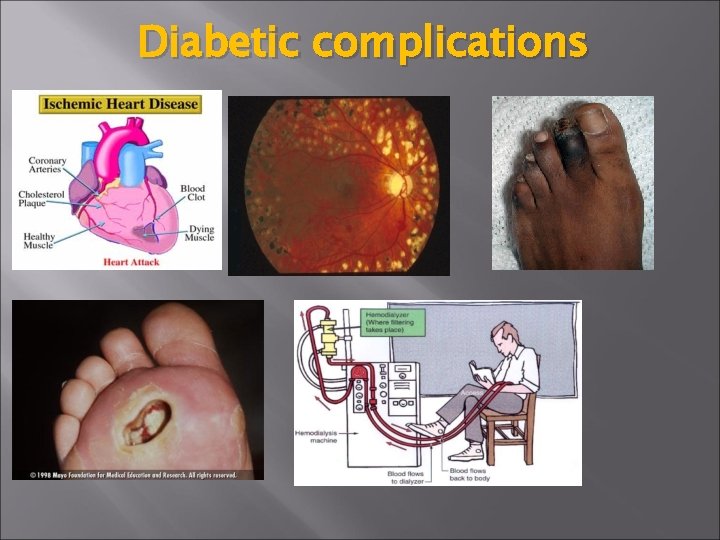 Diabetic complications 