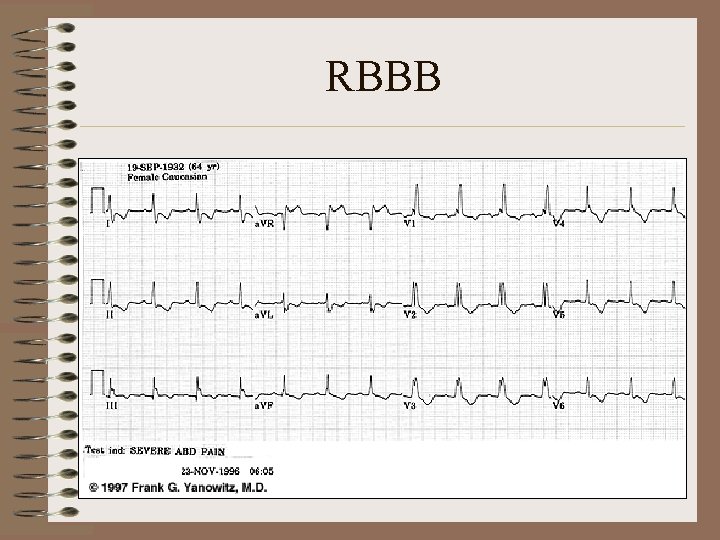 RBBB 