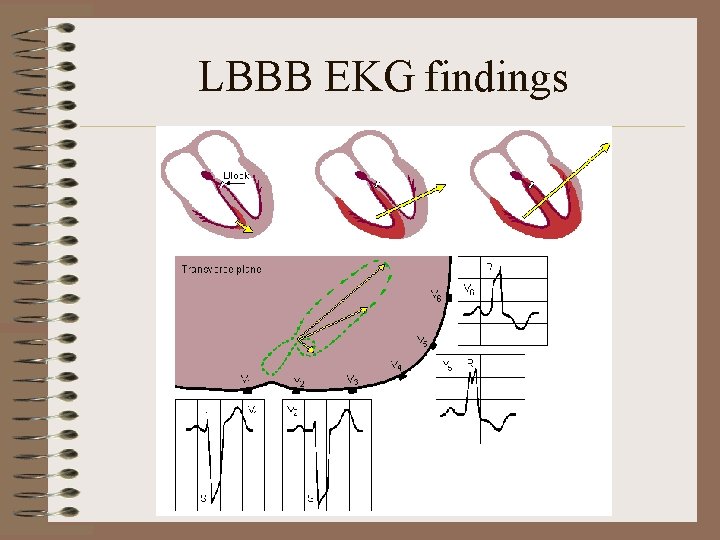 LBBB EKG findings 