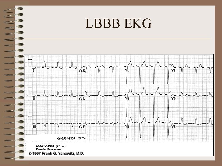 LBBB EKG 