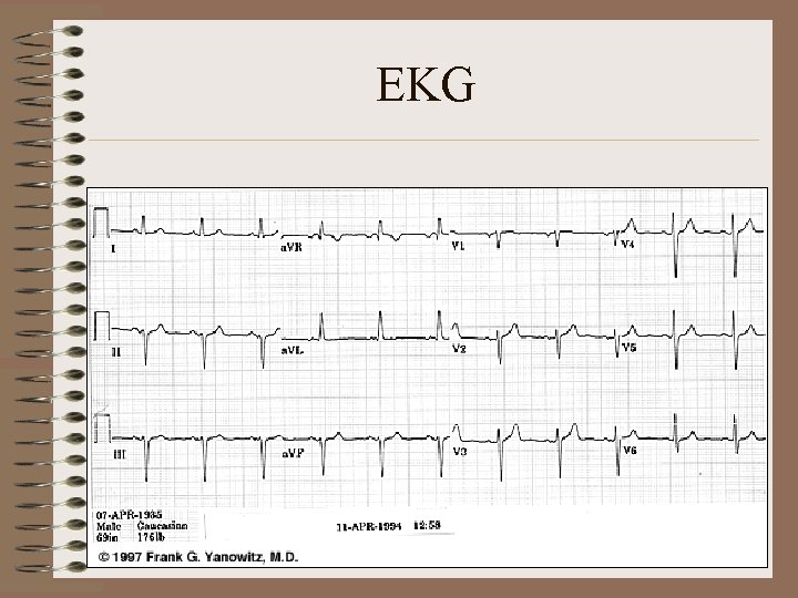 EKG 