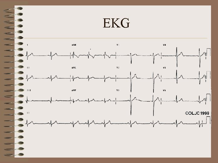 EKG 