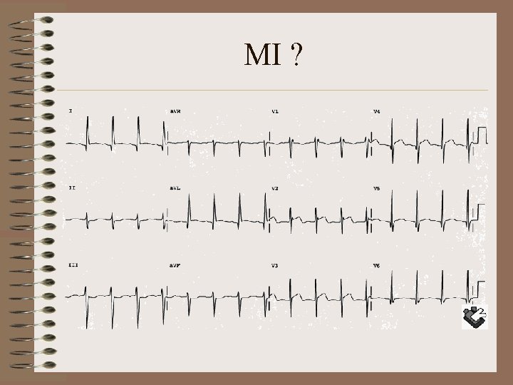 MI ? 