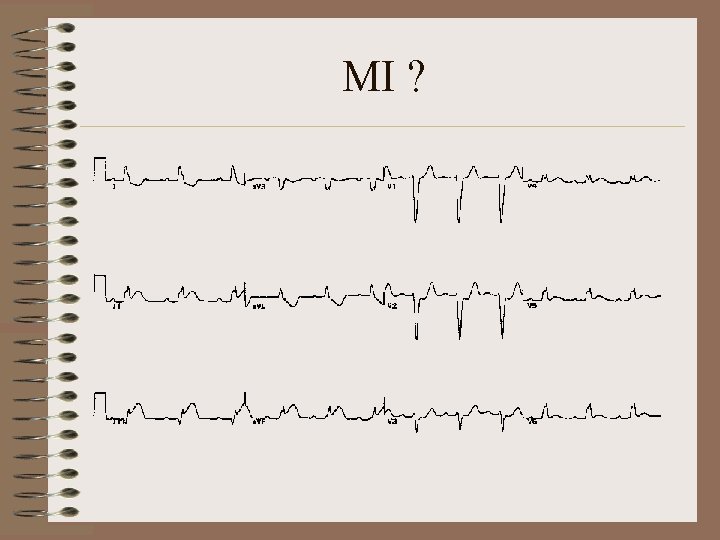 MI ? 