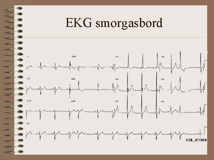 EKG smorgasbord 