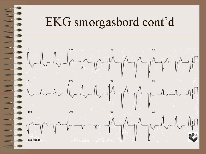 EKG smorgasbord cont’d 