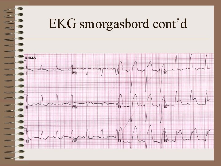 EKG smorgasbord cont’d 