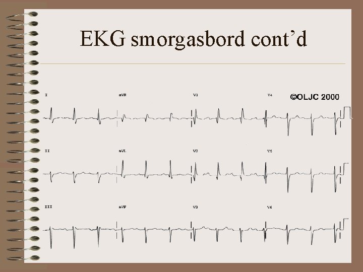 EKG smorgasbord cont’d 