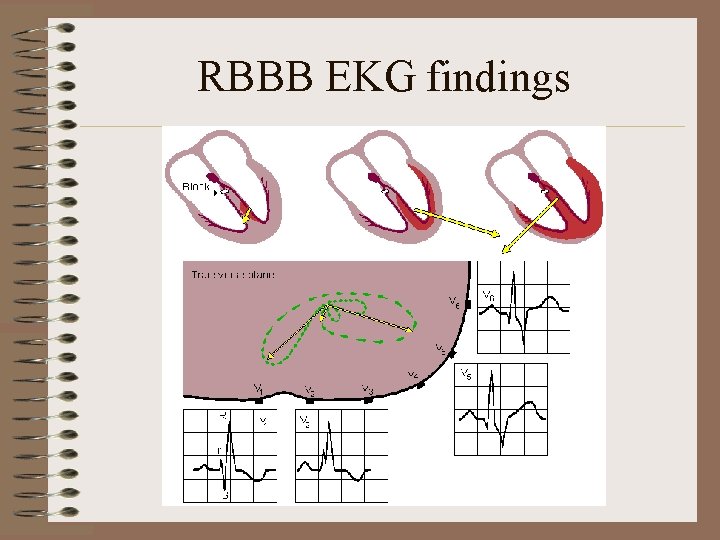 RBBB EKG findings 
