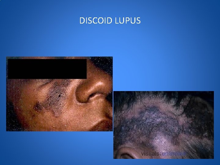 DISCOID LUPUS 