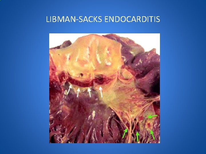 LIBMAN-SACKS ENDOCARDITIS 