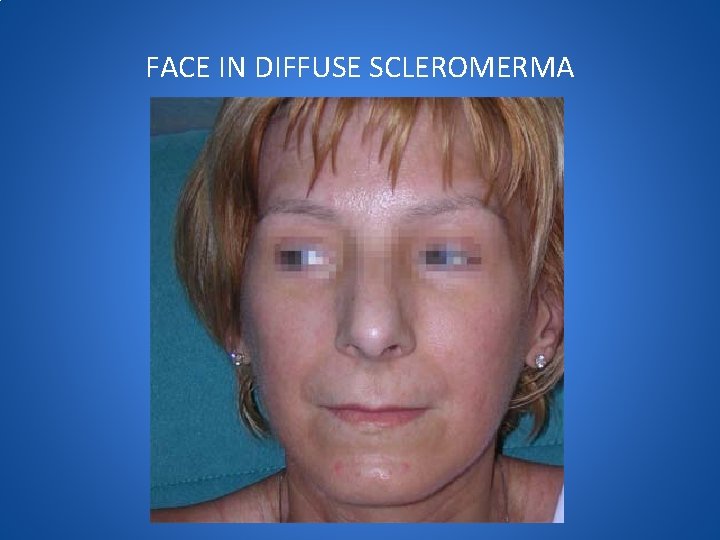 FACE IN DIFFUSE SCLEROMERMA 