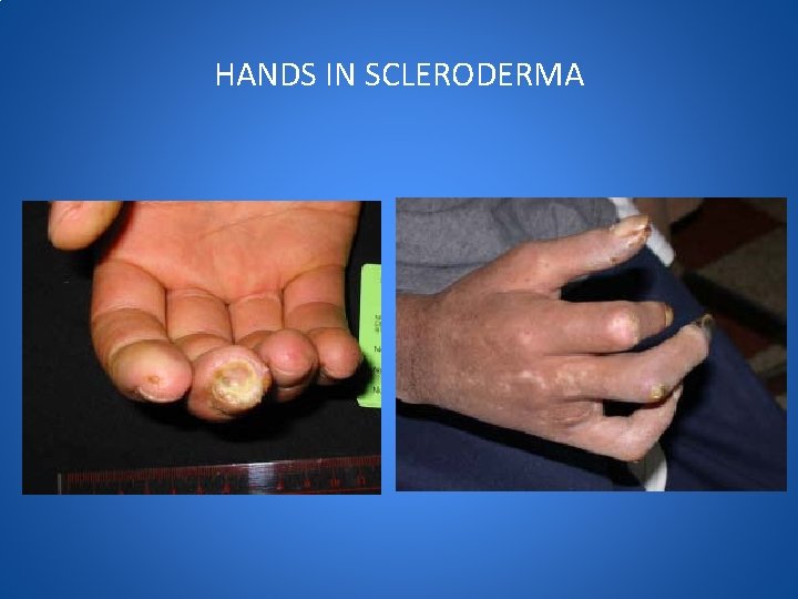 HANDS IN SCLERODERMA 