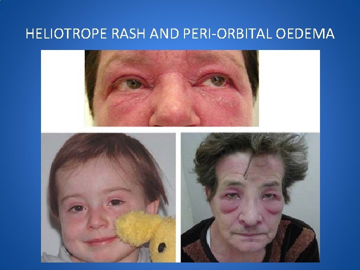 HELIOTROPE RASH AND PERI-ORBITAL OEDEMA 