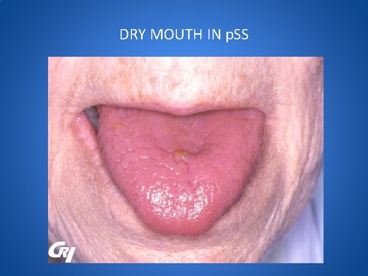 DRY MOUTH IN p. SS 
