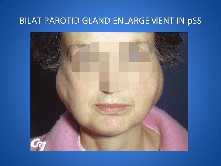 BILAT PAROTID GLAND ENLARGEMENT IN p. SS 