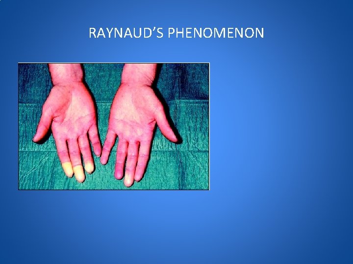 RAYNAUD’S PHENOMENON 