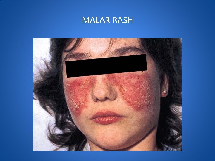 MALAR RASH 