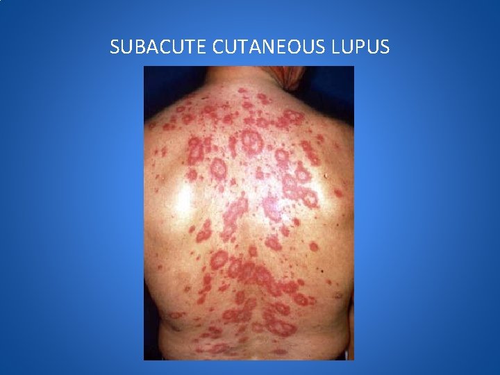 SUBACUTE CUTANEOUS LUPUS 