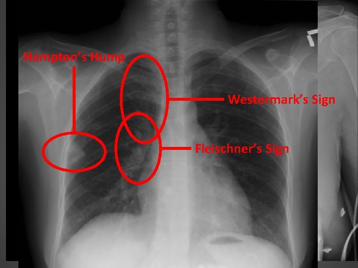 DIAGNOSIS OF PE – CXR Hampton’s Hump abnormal CXR in 84% in PIOPED e.