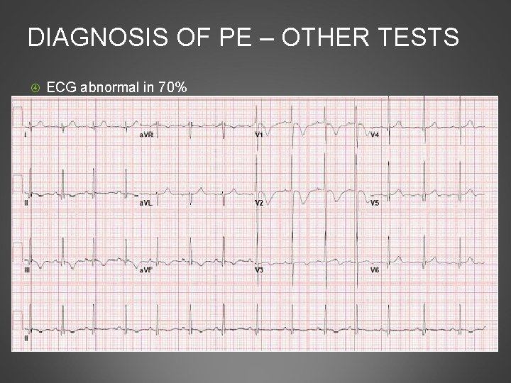 DIAGNOSIS OF PE – OTHER TESTS ECG abnormal in 70% Sinus tachycardia most common