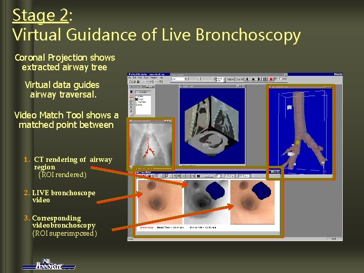 Stage 2: Virtual Guidance of Live Bronchoscopy Coronal Projection shows extracted airway tree Virtual