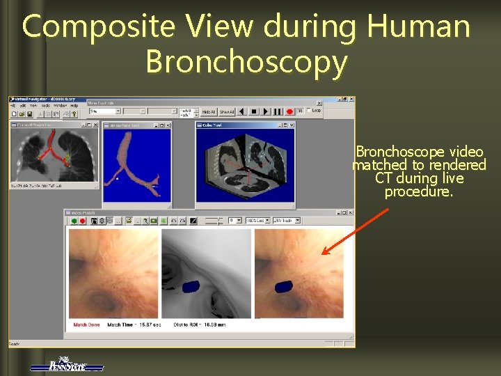 Composite View during Human Bronchoscopy Bronchoscope video matched to rendered CT during live procedure.