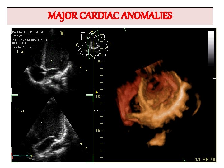 MAJOR CARDIAC ANOMALIES 