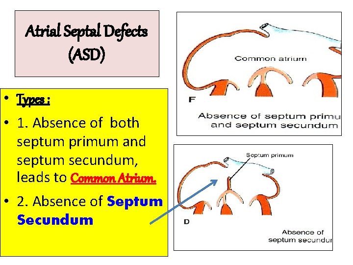 Atrial Septal Defects (ASD) • Types : • 1. Absence of both septum primum