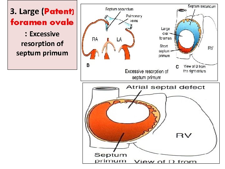 3. Large (Patent) foramen ovale : Excessive resorption of septum primum 