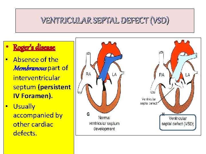 VENTRICULAR SEPTAL DEFECT (VSD) • Roger’s disease • Absence of the Membranous part of