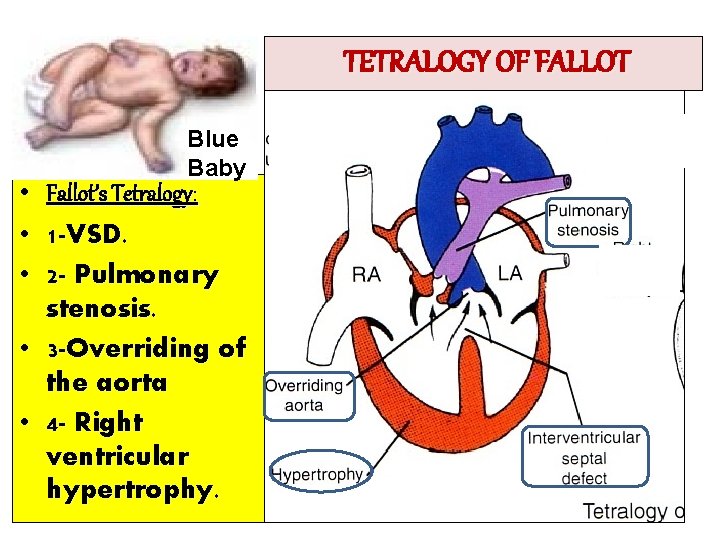 TETRALOGY OF FALLOT • • • Blue Baby Fallot’s Tetralogy: 1 -VSD. 2 -