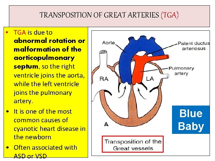 TRANSPOSITION OF GREAT ARTERIES (TGA) • TGA is due to abnormal rotation or malformation