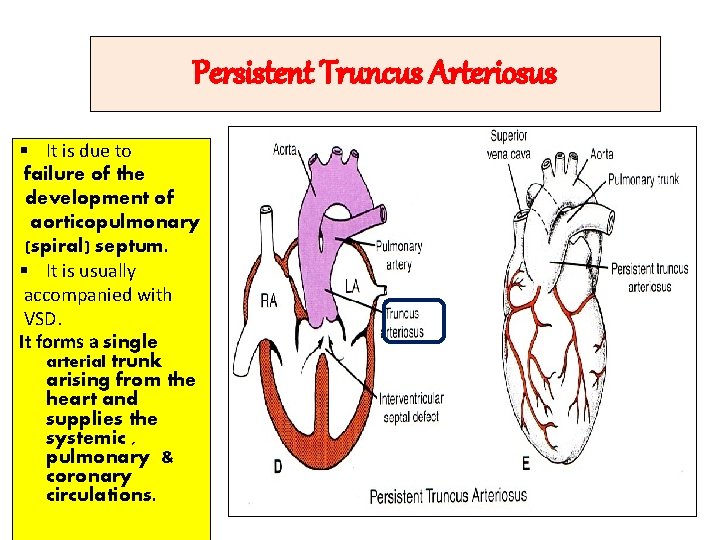 Persistent Truncus Arteriosus § It is due to failure of the development of aorticopulmonary