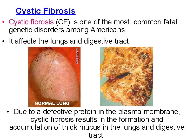 Cystic Fibrosis • Cystic fibrosis (CF) is one of the most common fatal genetic