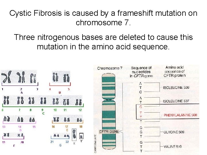 Cystic Fibrosis is caused by a frameshift mutation on chromosome 7. Three nitrogenous bases