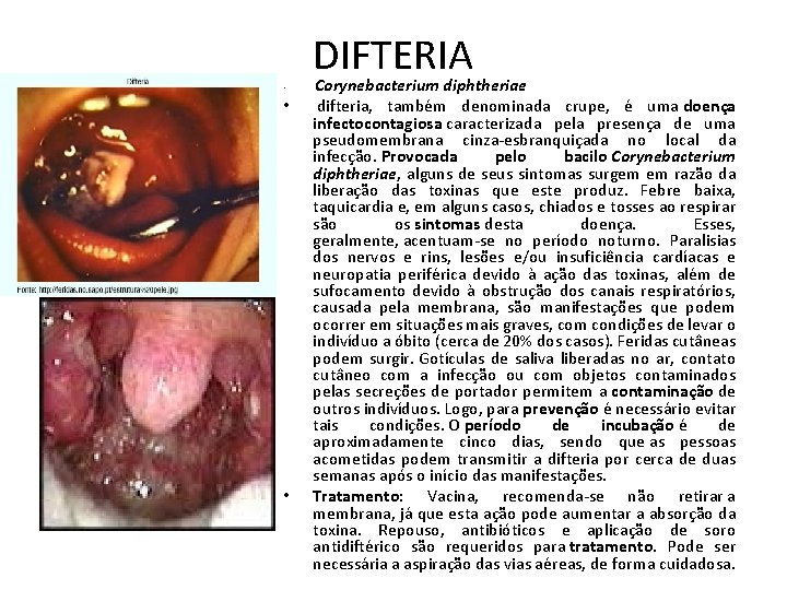 DIFTERIA • • • Corynebacterium diphtheriae difteria, também denominada crupe, é uma doença infectocontagiosa